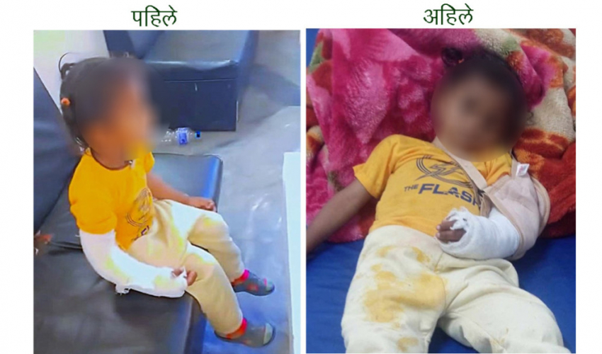 देब्रे हात भाँच्चिएका बालकको दाहिनेमा प्लास्टर